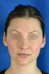 Rhinoplasty case #3492