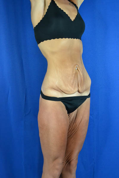 Abdominoplasty case #3292