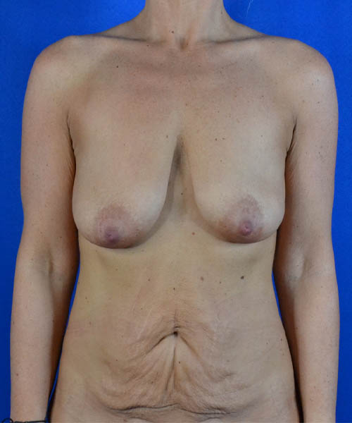 Breast Lift case #3517