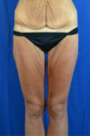 Thigh Lift case #3337