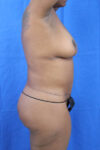 Abdominoplasty case #3309