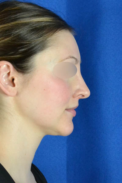 Rhinoplasty case #3492