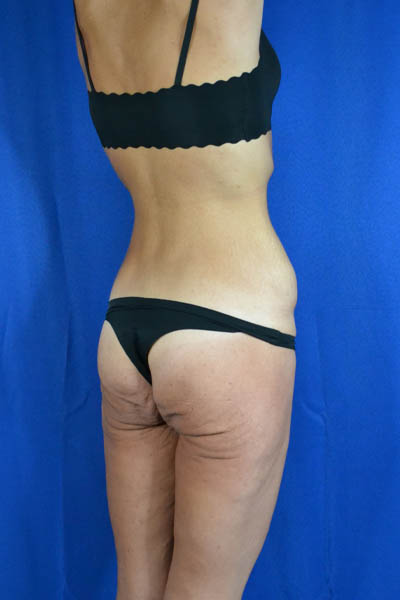 Abdominoplasty case #3292