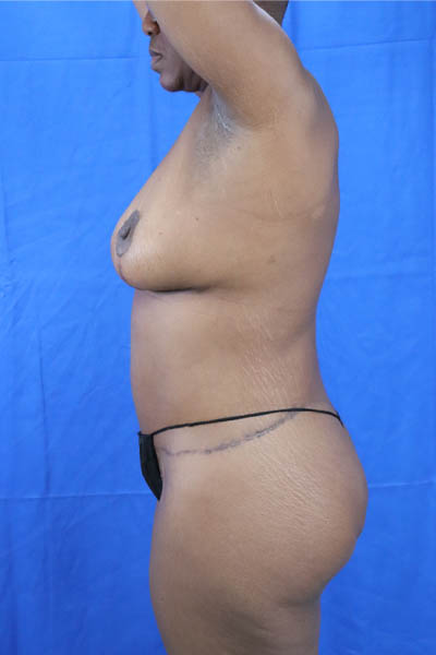 Abdominoplasty case #3309