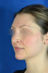 Rhinoplasty case #3492