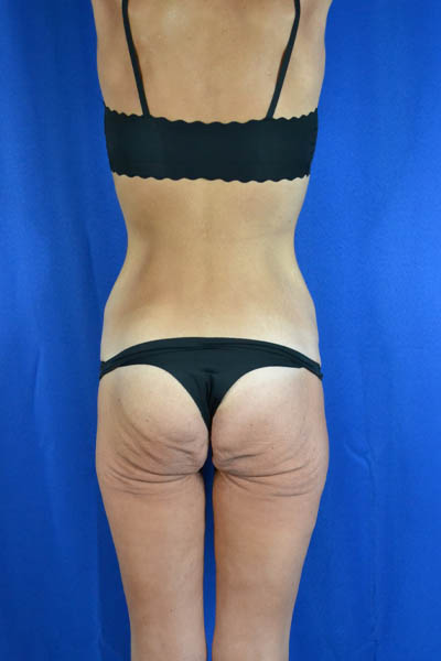 Abdominoplasty case #3292