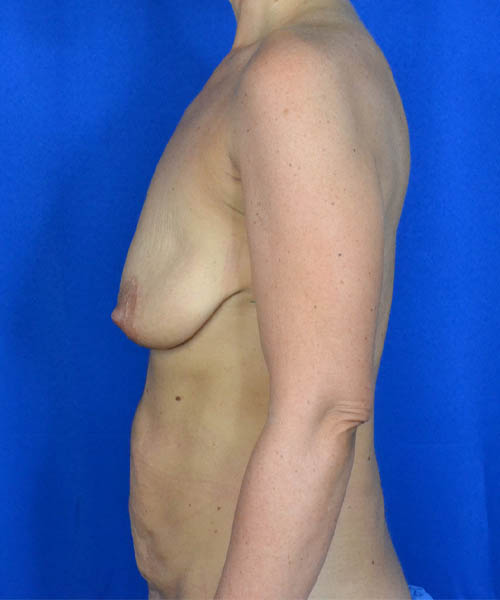 Breast Lift case #3517