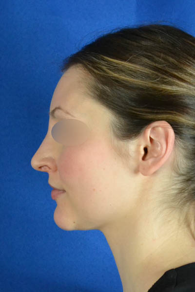 Rhinoplasty case #3492