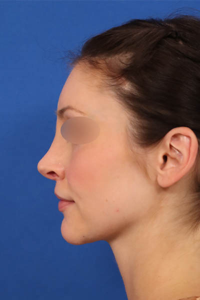 Rhinoplasty case #3492