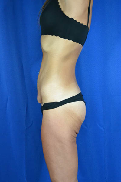 Abdominoplasty case #3292