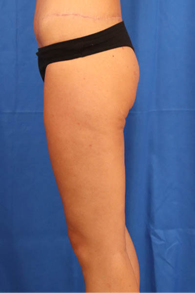 Thigh Lift case #3337