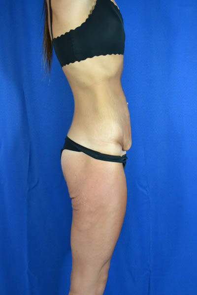 Abdominoplasty case #3292