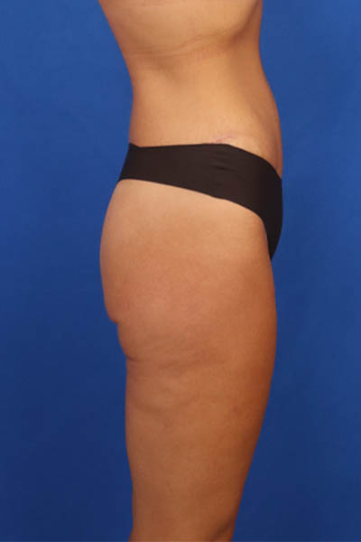 Thigh Lift case #3337