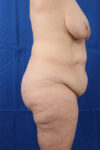 Abdominoplasty case #3322