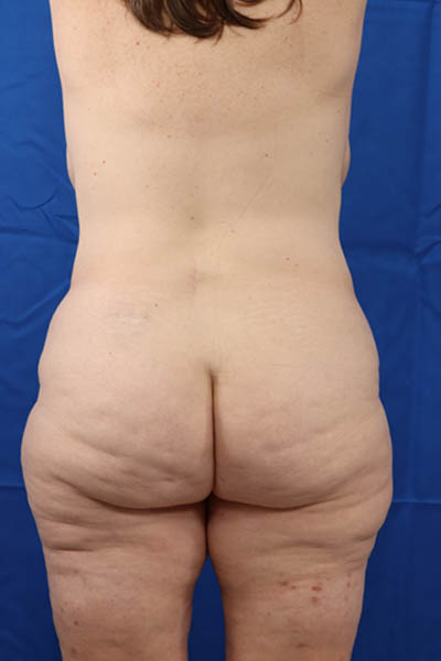 Abdominoplasty case #3322