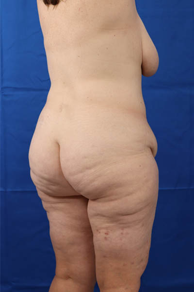 Abdominoplasty case #3322