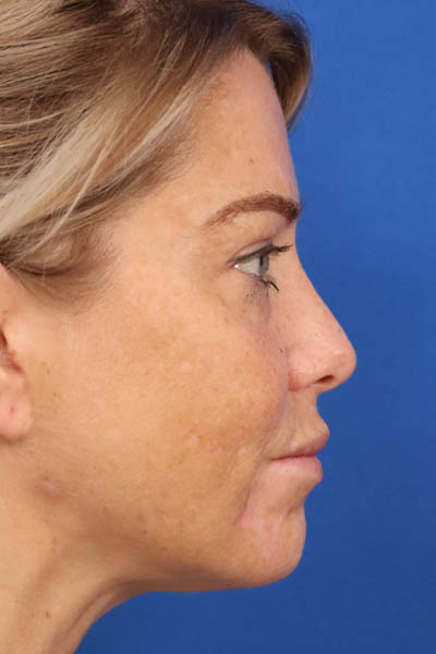 Buccal Fat Removal case #3907