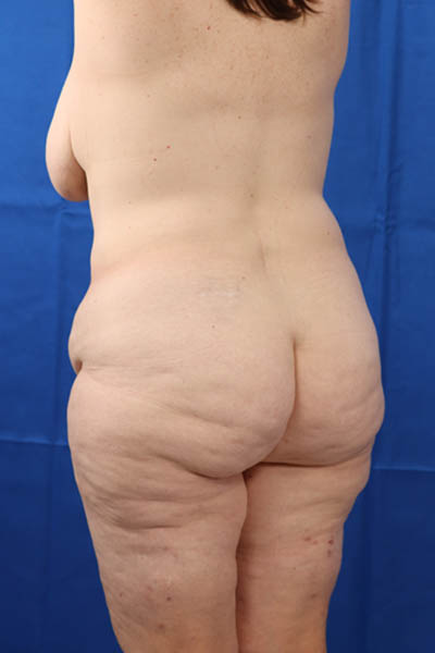 Abdominoplasty case #3322