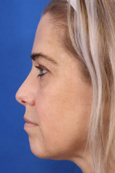 Buccal Fat Removal case #3907