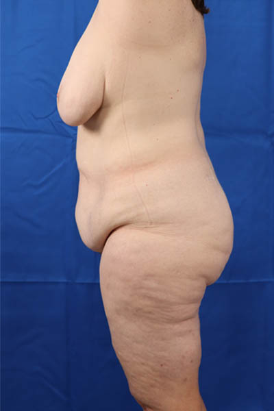 Abdominoplasty case #3322