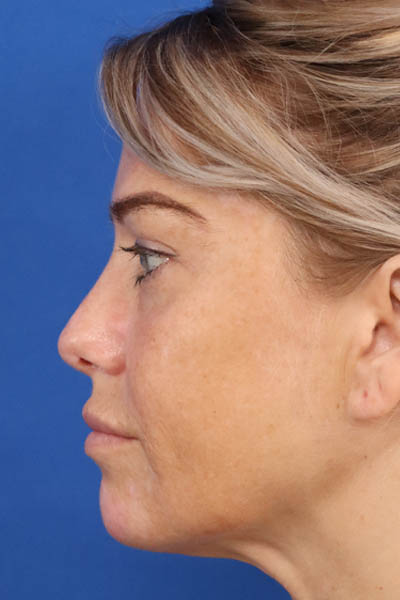 Buccal Fat Removal case #3907