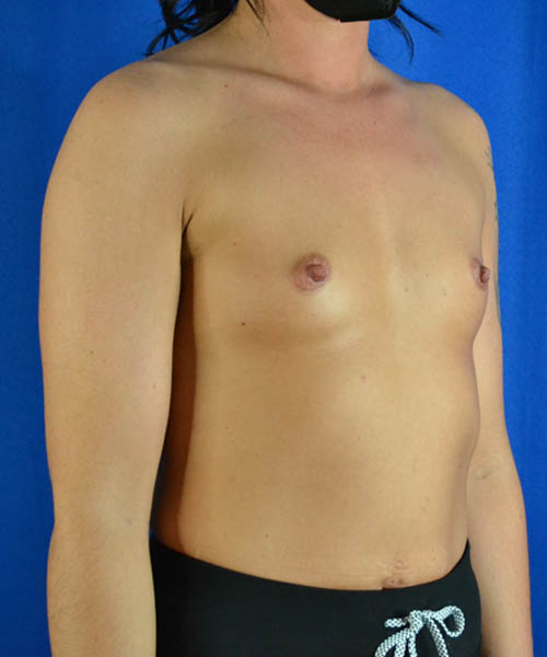 Breast Augmentation case #3438