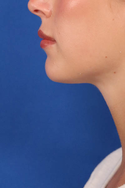 Neck Liposuction case #3928