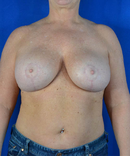 Breast Augmentation + Lift case #3625