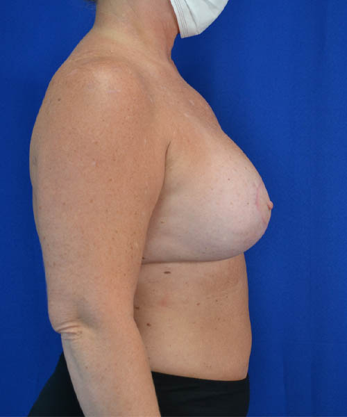 Breast Augmentation + Lift case #3625