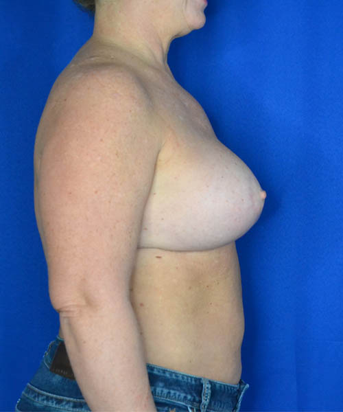 Breast Augmentation + Lift case #3625