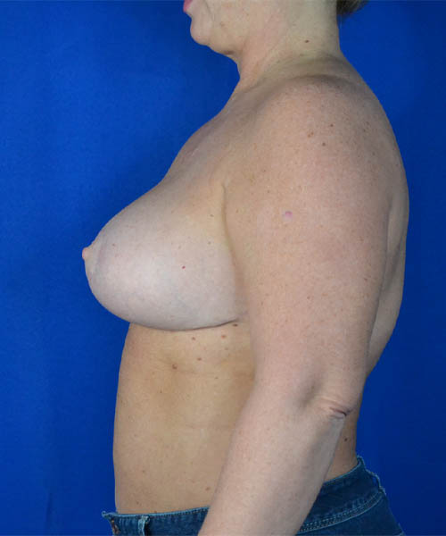 Breast Augmentation + Lift case #3625