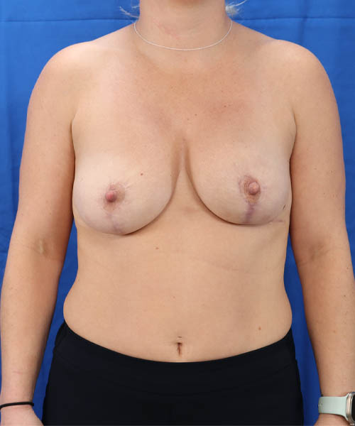 Breast Reduction case #3636