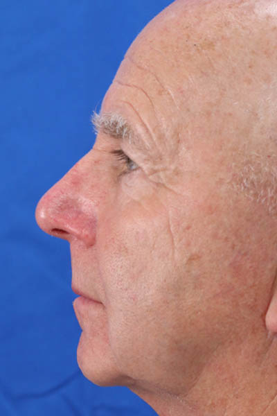 Blepharoplasty case #3951