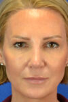 Blepharoplasty case #3964