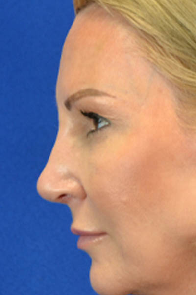 Blepharoplasty case #3964