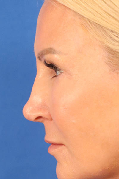 Blepharoplasty case #3964