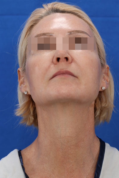 Facelift case #3728