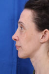 Rhinoplasty case #3481