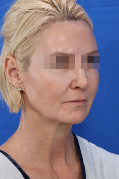 Facelift case #3728