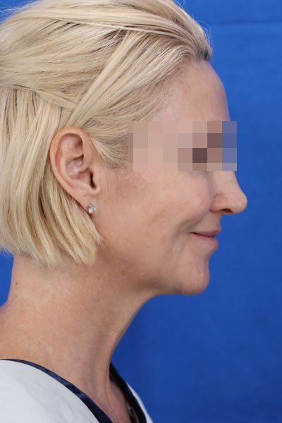 Facelift case #3728