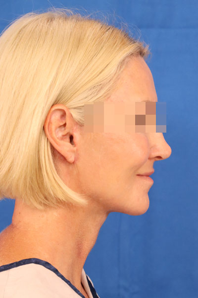 Facelift case #3728