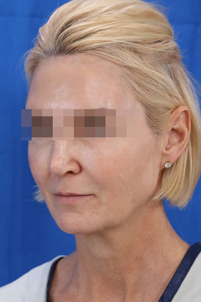 Facelift case #3728