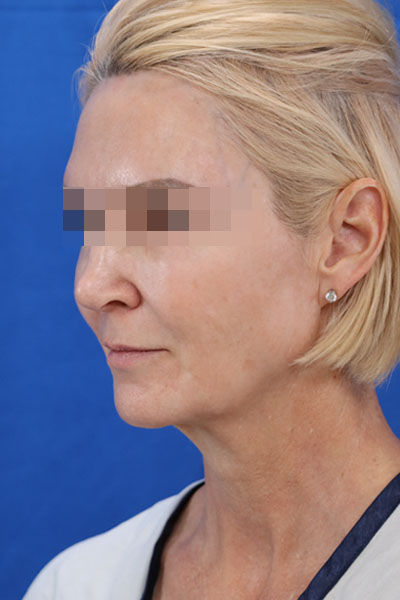 Facelift case #3728