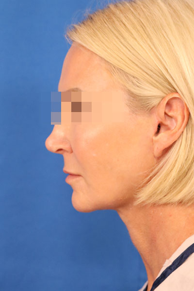 Facelift case #3728