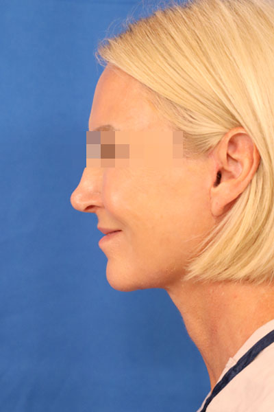 Facelift case #3728