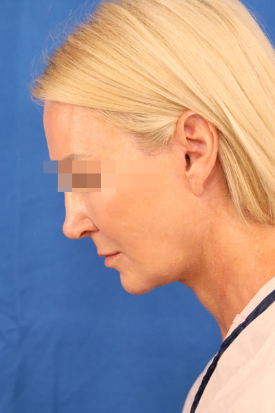 Facelift case #3728