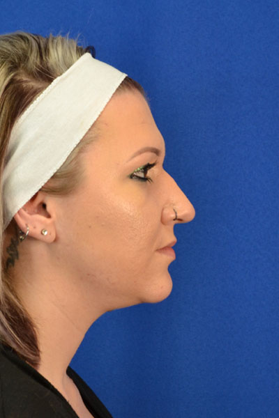 Rhinoplasty case #3503