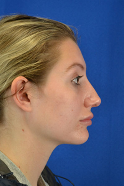 Revision Rhinoplasty case #3575