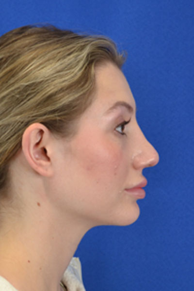 Revision Rhinoplasty case #3575