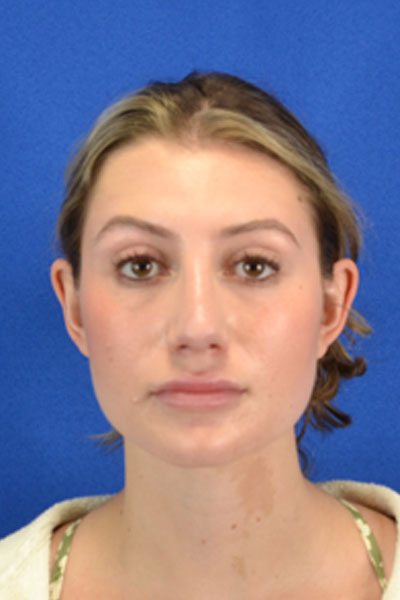 Revision Rhinoplasty case #3575